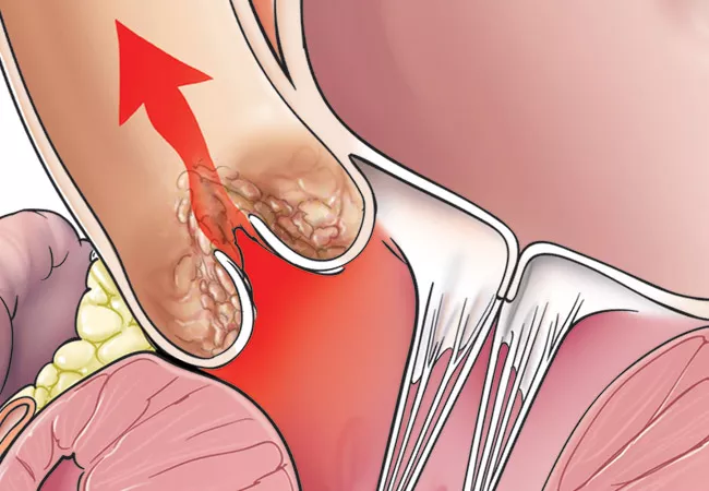 صمام أبهري متضيّق ومتكلّس يعيق تدفّق الدم